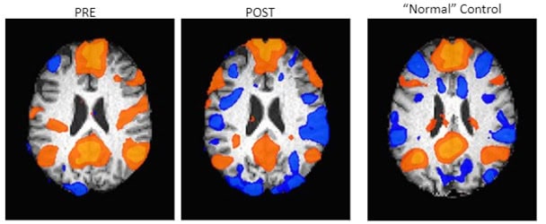 fmri